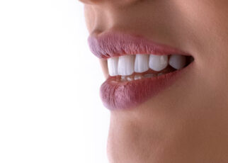 Implantes dentales