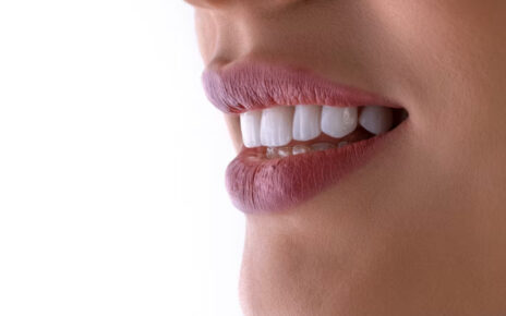 Implantes dentales
