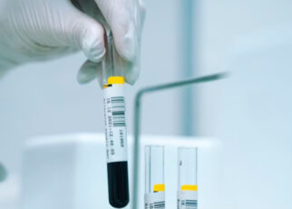 Urea alta en sangre