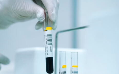 Urea alta en sangre