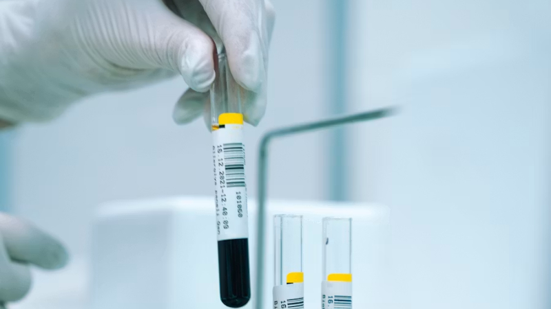 Urea alta en sangre
